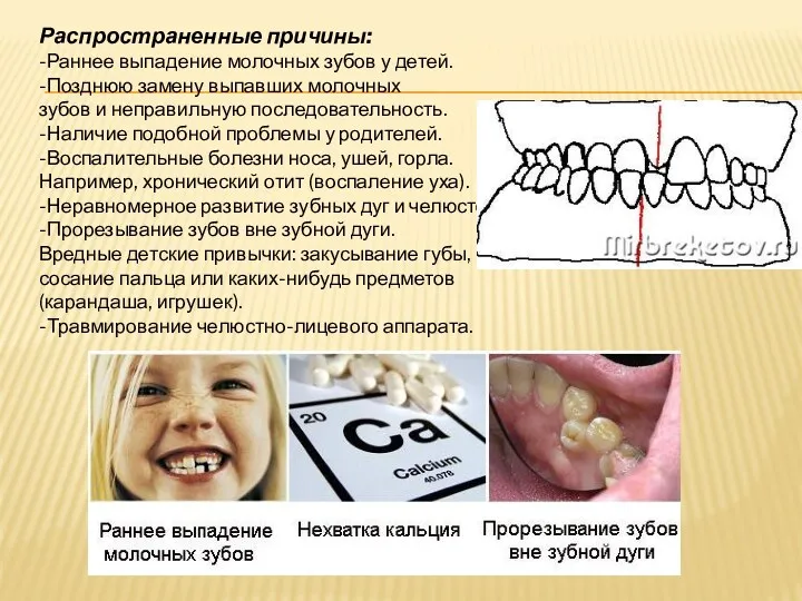 Распространенные причины: -Раннее выпадение молочных зубов у детей. -Позднюю замену выпавших молочных зубов