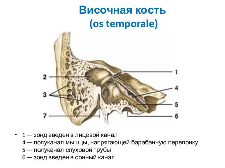 Височная кость (os temporale) 1 — зонд введен в лицевой