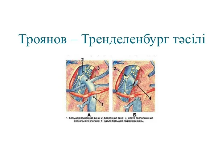 Троянов – Тренделенбург тәсілі