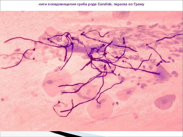 нити псевдомицелия гриба рода Candida, окраска по Граму