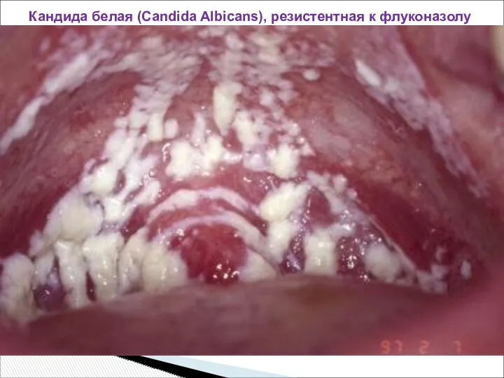 Кандида белая (Candida Albicans), резистентная к флуконазолу