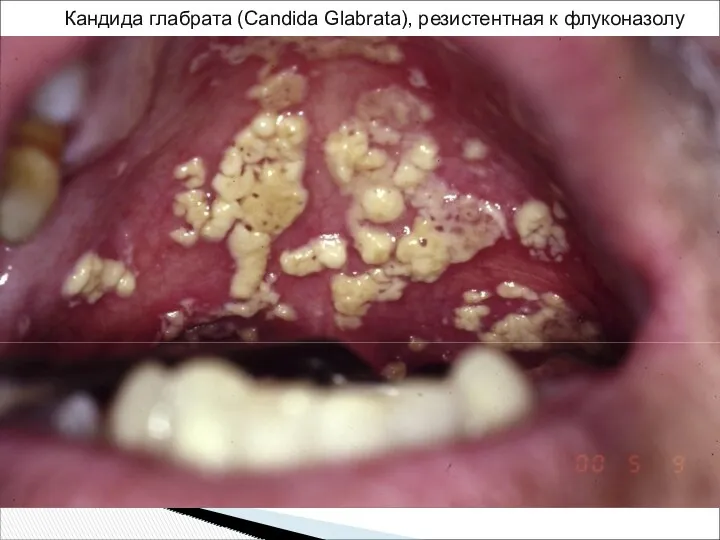 Кандида глабрата (Candida Glabrata), резистентная к флуконазолу