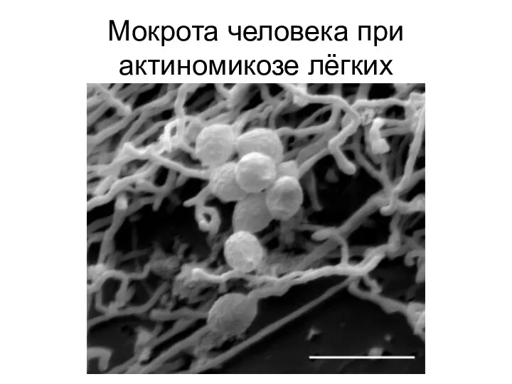 Мокрота человека при актиномикозе лёгких