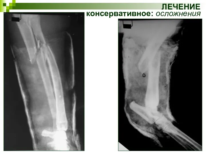 ЛЕЧЕНИЕ консервативное: осложнения