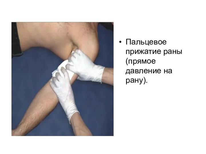 Пальцевое прижатие раны (прямое давление на рану).