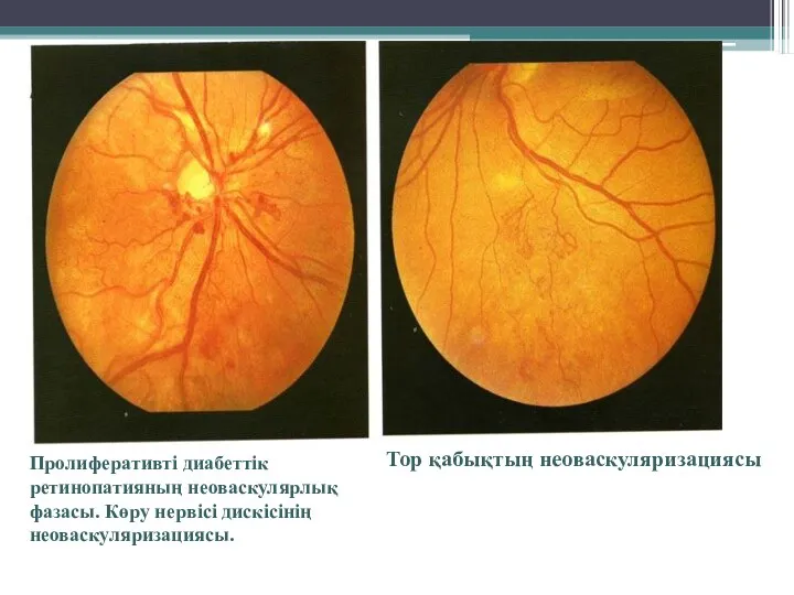 Пролиферативті диабеттік ретинопатияның неоваскулярлық фазасы. Көру нервісі дискісінің неоваскуляризациясы. Тор қабықтың неоваскуляризациясы