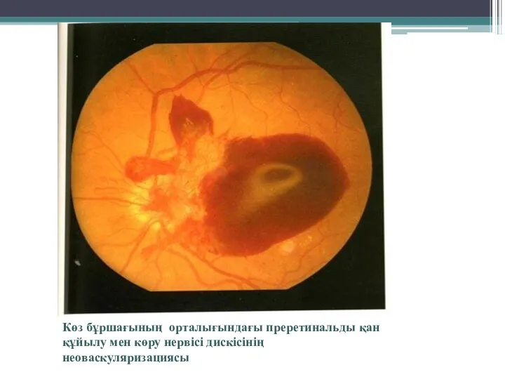 Көз бұршағының орталығындағы преретинальды қан құйылу мен көру нервісі дискісінің неоваскуляризациясы