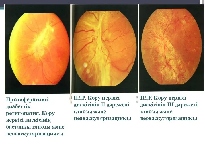 Пролиферативті диабеттік ретинопатия. Көру нервісі дискісінің бастапқы глиозы және неоваскуляризациясы ПДР. Көру нервісі