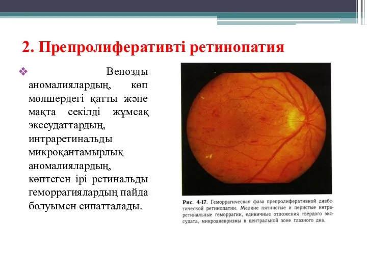 2. Препролиферативті ретинопатия Венозды аномалиялардың, көп мөлшердегі қатты және мақта секілді жұмсақ экссудаттардың,