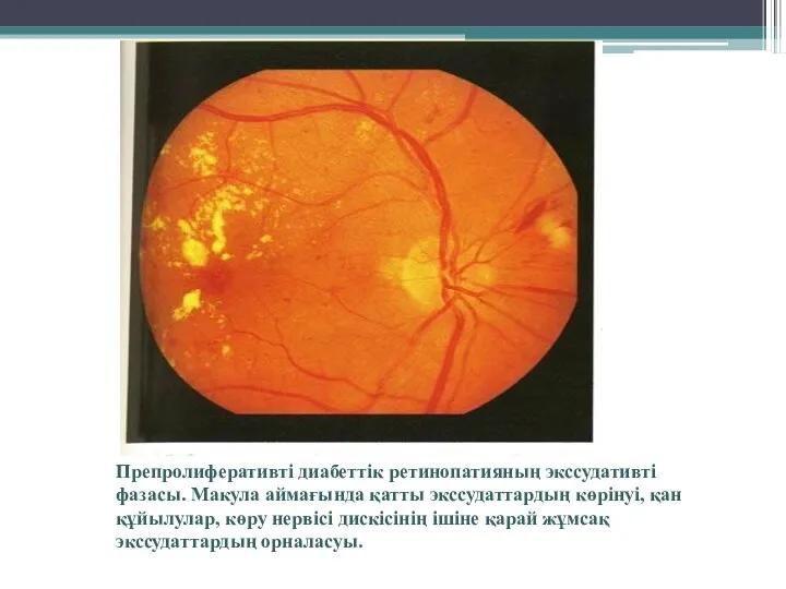 Препролиферативті диабеттік ретинопатияның экссудативті фазасы. Макула аймағында қатты экссудаттардың көрінуі, қан құйылулар, көру
