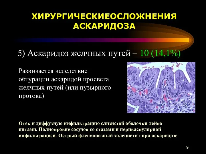5) Аскаридоз желчных путей – 10 (14,1%) ХИРУРГИЧЕСКИЕОСЛОЖНЕНИЯ АСКАРИДОЗА Отек
