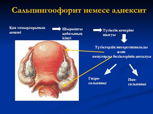 Сальпингоофорит немесе аднексит Қан тамырларының кеңеюі Шырышты қабатының ісінуі Түтіктің