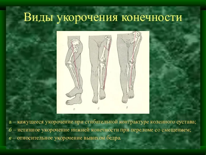 Виды укорочения конечности а – кажущееся укорочение при сгибательной контрактуре коленного сустава; б