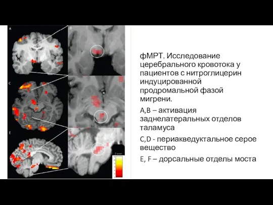 фМРТ. Исследование церебрального кровотока у пациентов с нитроглицерин индуцированной продромальной