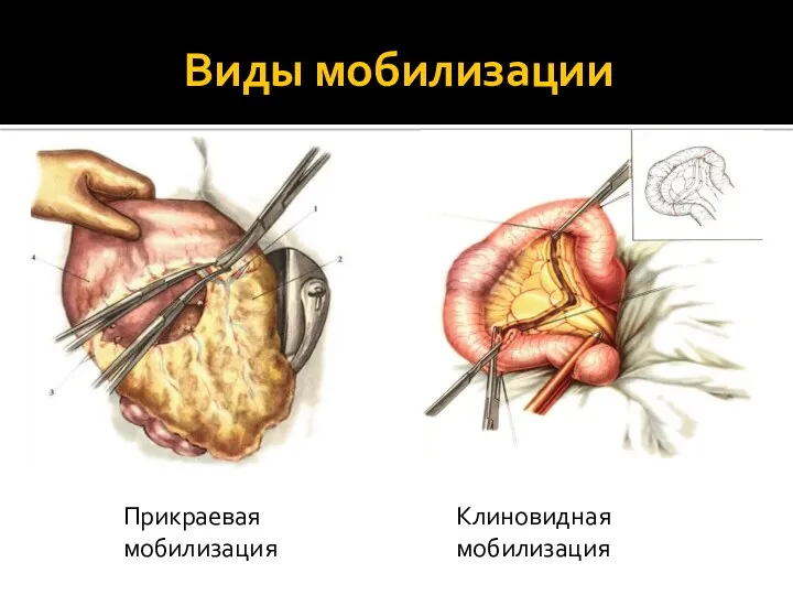 Виды мобилизации Прикраевая мобилизация Клиновидная мобилизация