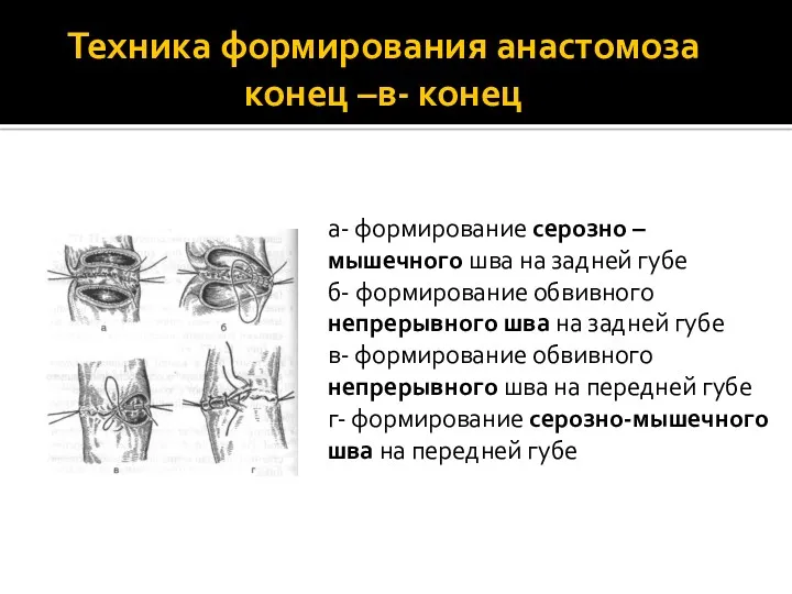 Техника формирования анастомоза конец –в- конец а- формирование серозно –