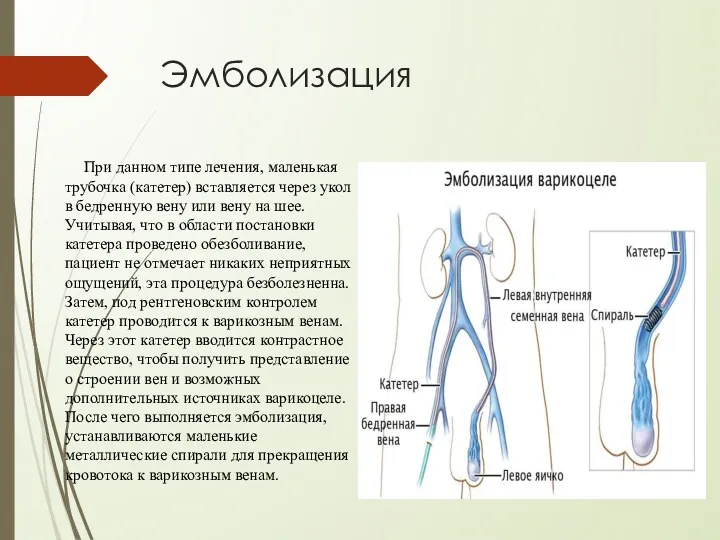 Эмболизация При данном типе лечения, маленькая трубочка (катетер) вставляется через