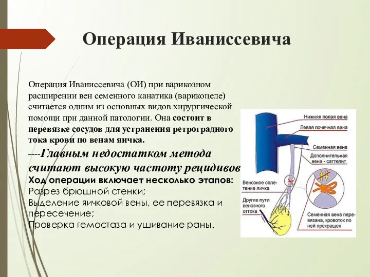 Операция Иваниссевича Операция Иваниссевича (ОИ) при варикозном расширении вен семенного канатика (варикоцеле) считается