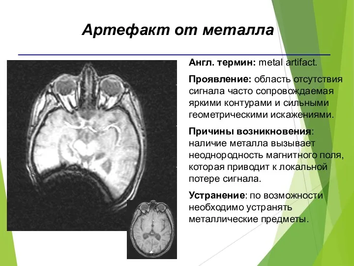 Англ. термин: metal artifact. Проявление: область отсутствия сигнала часто сопровождаемая