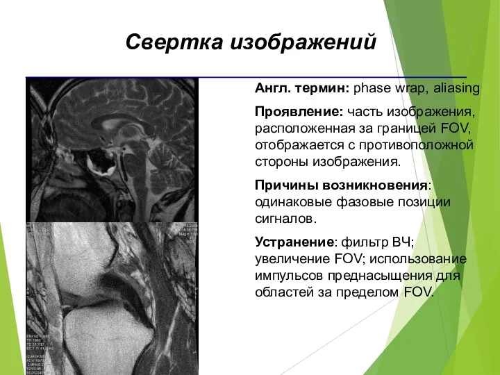 Англ. термин: phase wrap, aliasing Проявление: часть изображения, расположенная за