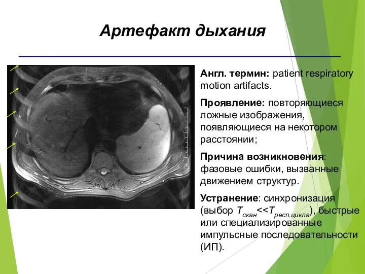 Англ. термин: patient respiratory motion artifacts. Проявление: повторяющиеся ложные изображения,