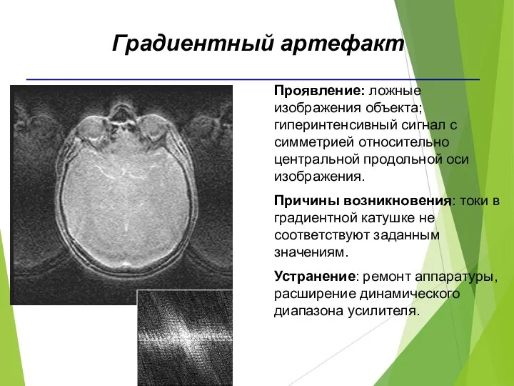 Проявление: ложные изображения объекта; гиперинтенсивный сигнал с симметрией относительно центральной