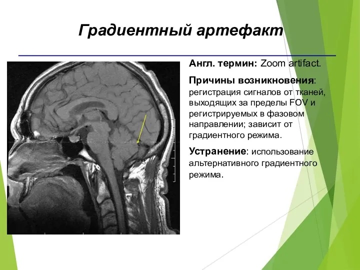 Англ. термин: Zoom artifact. Причины возникновения: регистрация сигналов от тканей,