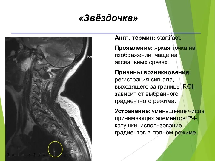 Англ. термин: startifact. Проявление: яркая точка на изображении, чаще на