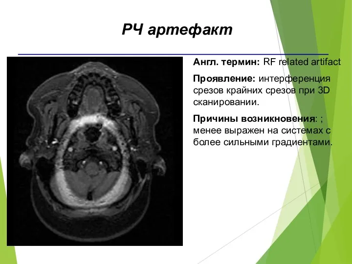 Англ. термин: RF related artifact Проявление: интерференция срезов крайних срезов