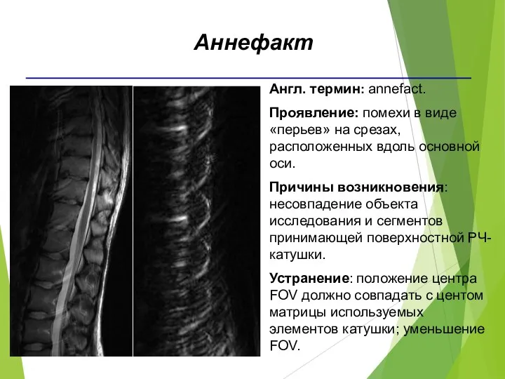 Англ. термин: annefact. Проявление: помехи в виде «перьев» на срезах,