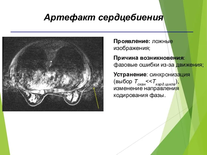 Проявление: ложные изображения; Причина возникновения: фазовые ошибки из-за движения; Устранение: синхронизация (выбор Тскан Артефакт сердцебиения