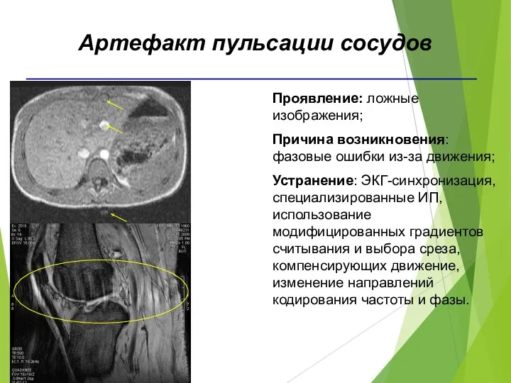 Артефакт пульсации сосудов Проявление: ложные изображения; Причина возникновения: фазовые ошибки