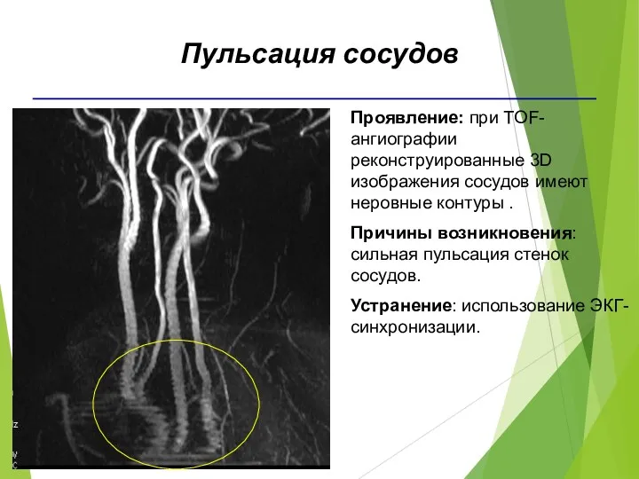 Проявление: при TOF-ангиографии реконструированные 3D изображения сосудов имеют неровные контуры