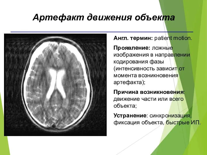 Англ. термин: patient motion. Проявление: ложные изображения в направлении кодирования