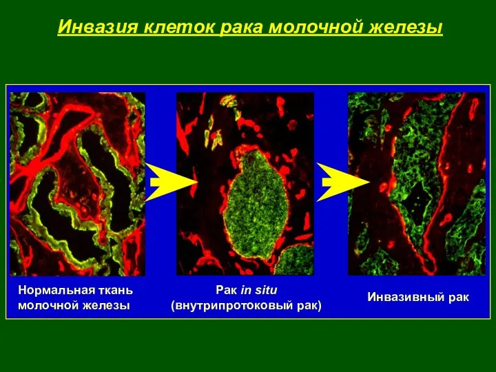 Инвазия клеток рака молочной железы Нормальная ткань молочной железы Рак in situ (внутрипротоковый рак) Инвазивный рак