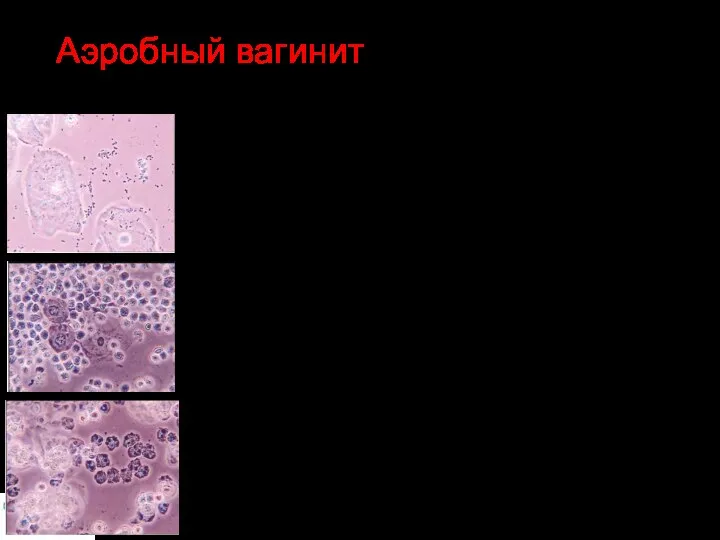 Преобладание кокковой флоры и отсутствие лактобактерий Присутствие парабазальных клеток Наличие