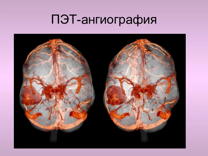 ПЭТ-ангиография