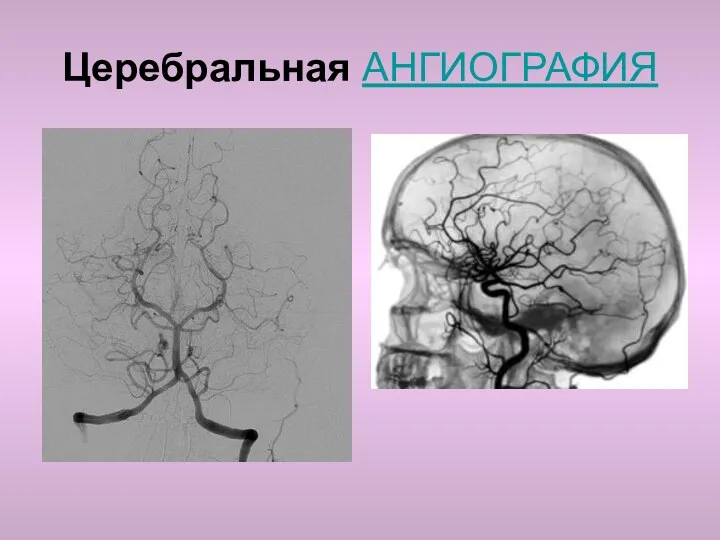 Церебральная АНГИОГРАФИЯ