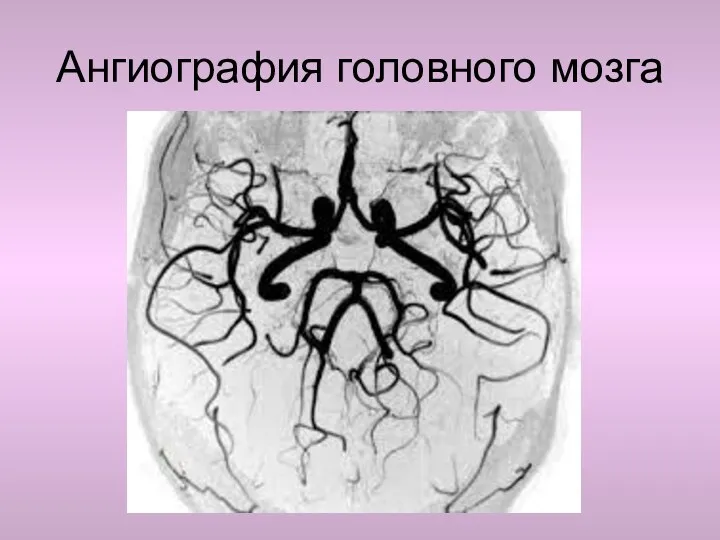 Ангиография головного мозга