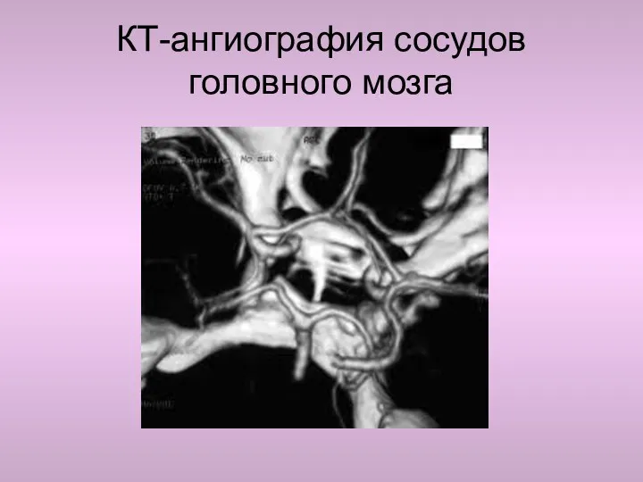 КТ-ангиография сосудов головного мозга