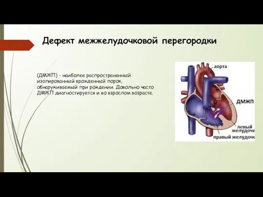 Дефект межжелудочковой перегородки (ДМЖП) - наиболее распространенный изолированный врожденный порок,