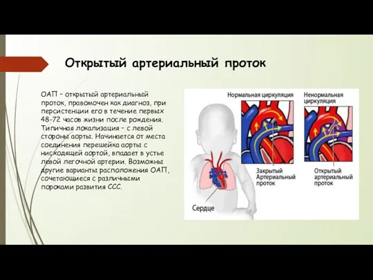 Открытый артериальный проток ОАП – открытый артериальный проток, правомочен как