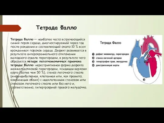 Тетрада Фалло Тетрада Фалло — наиболее часто встречающийся синий порок