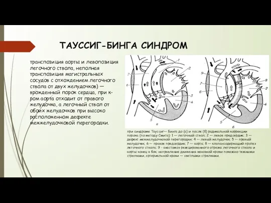 ТАУССИГ-БИНГА СИНДРОМ транспозиция аорты и левопозиция легочного ствола, неполная транспозиция