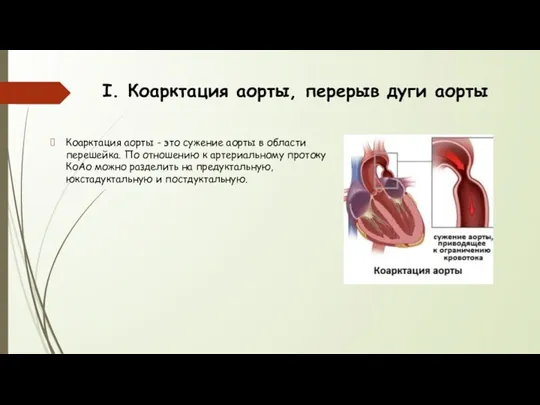 I. Коарктация аорты, перерыв дуги аорты Коарктация аорты - это