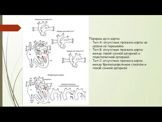 Перерыв дуги аорты: Тип А: отсутствие просвета аорты на уровне