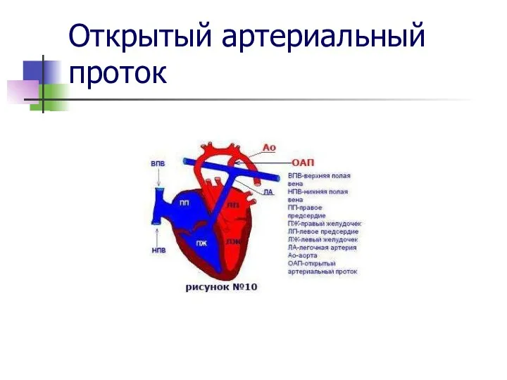 Открытый артериальный проток