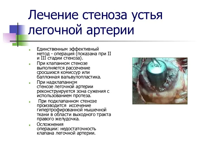 Лечение стеноза устья легочной артерии Единственным эффективный метод - операция