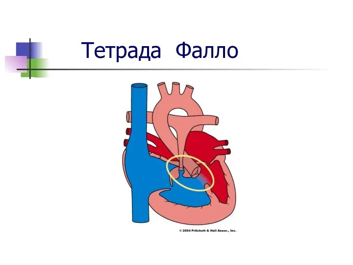 Тетрада Фалло