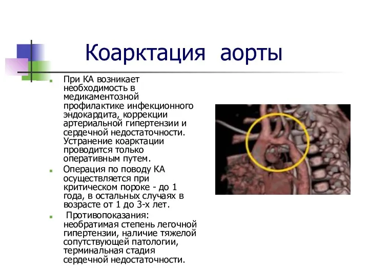 Коарктация аорты При КА возникает необходимость в медикаментозной профилактике инфекционного